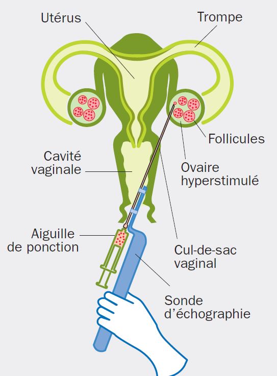 Fécondation in vitro (FIV)